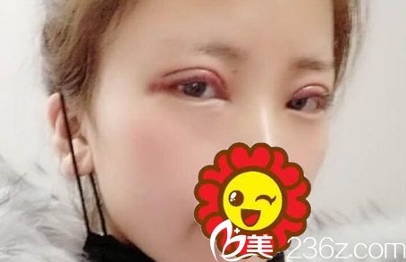 切開雙眼皮第二天眼睛很腫