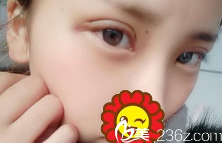割雙眼皮第三天效果