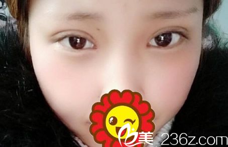 全切雙眼皮+開眼角第七天拆線后