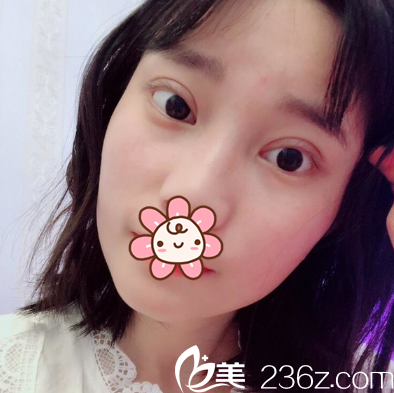 程紅濤切開雙眼皮術(shù)后11天效果