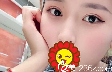 曬一下?酒泉華美整形楊艷給我割雙眼皮1-7天的恢復(fù)圖 開眼角也一起做了