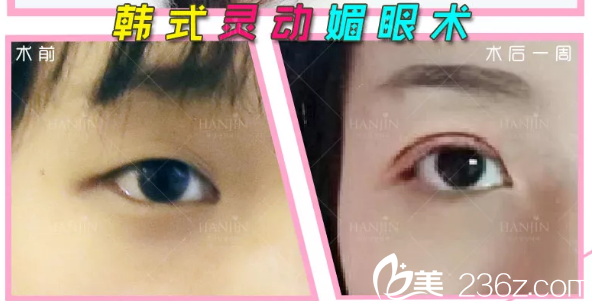 周創(chuàng)業(yè)雙眼皮案例 周創(chuàng)業(yè)雙眼皮案例