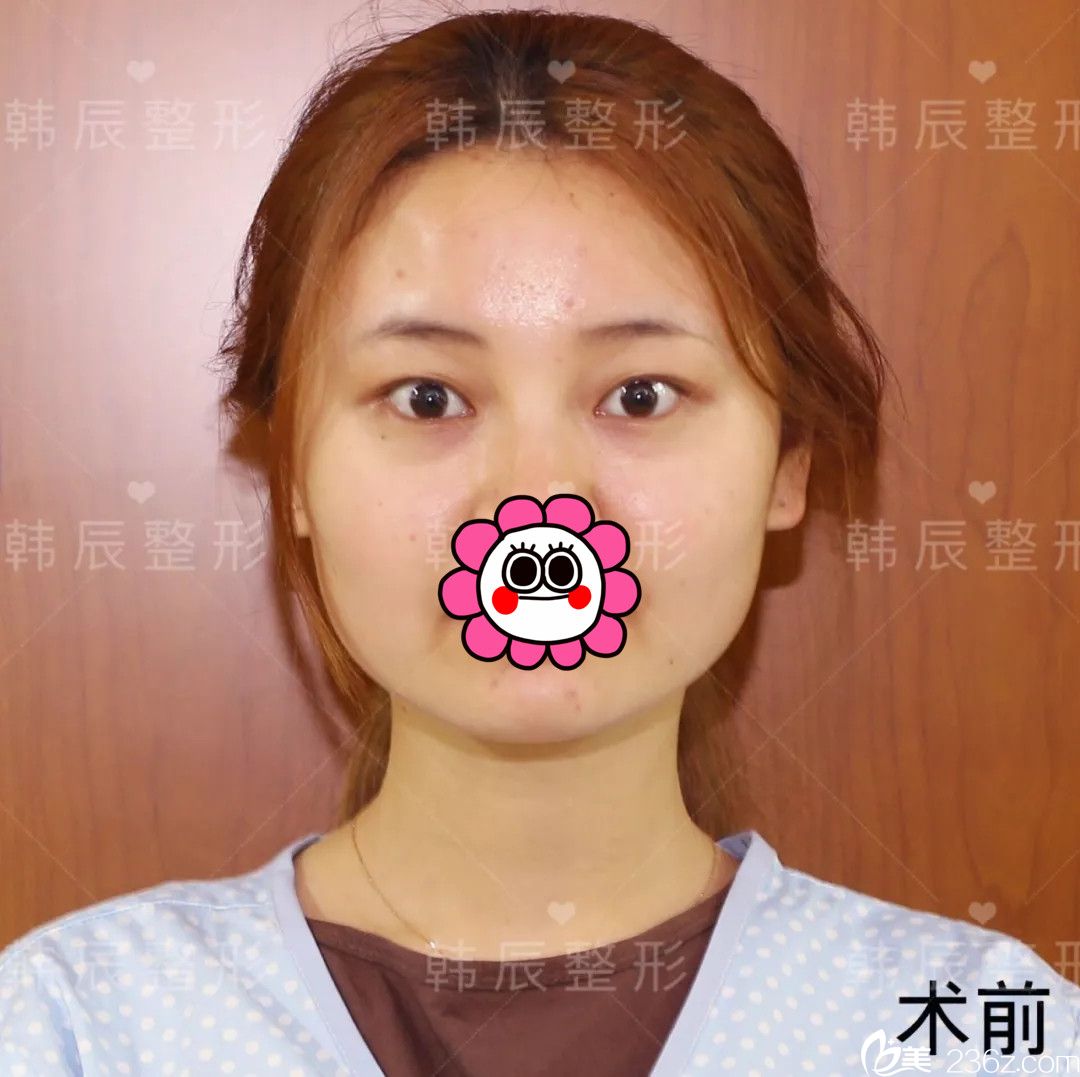 術(shù)前單眼皮 術(shù)前單眼皮