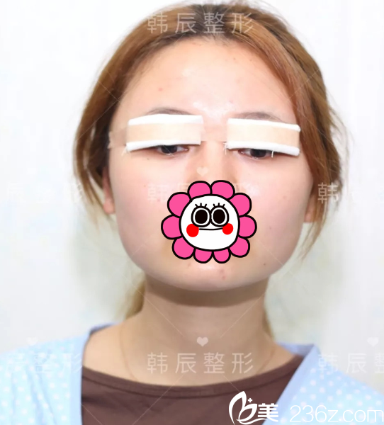 剛做完眼綜合整形手術(shù) 剛做完眼綜合整形手術(shù)