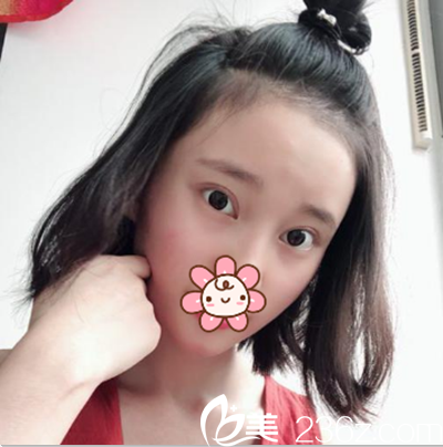 成都艾米麗切開雙眼皮術(shù)后3個月效果