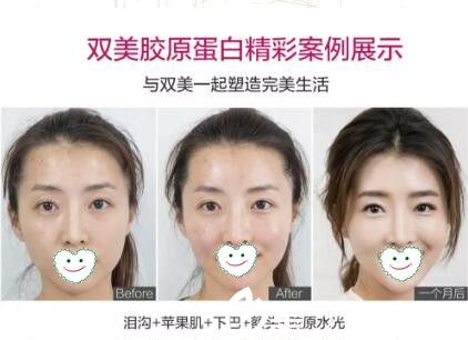 雙美膠原蛋白真人案例前后效果展示
