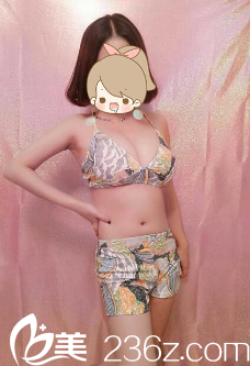 貴陽華美黃皓假體豐胸術后三個月效果 貴陽華美黃皓假體豐胸術后三個月效果