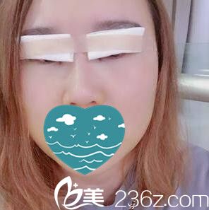 雙眼皮+開眼角術(shù)后即刻效果