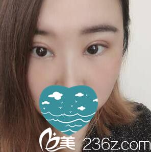 做雙眼皮+開眼角術(shù)后一周拆線