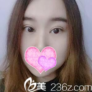 在丹東做雙眼皮+開眼角術(shù)后半個月情況
