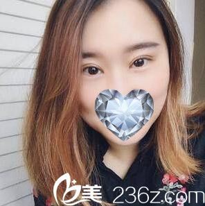 丹東哪家割雙眼皮好？分享我在富雅華醫(yī)整形做雙眼皮+開眼角術(shù)后30天恢復(fù)效果圖