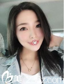 錢剛面部吸脂術(shù)后一個(gè)月