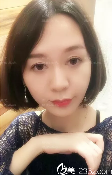 6d面部埋線治療后生活照