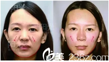 <!--<i data=20240703-sp></i>-->6d面部治療前后對比圖