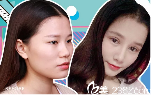 深圳美萊陳磊做的雙眼皮隆鼻案例 深圳美萊陳磊做的雙眼皮隆鼻案例
