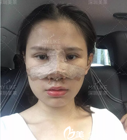 深圳美萊陳磊做的雙眼皮隆鼻7天案例效果 深圳美萊陳磊做的雙眼皮隆鼻7天案例效果