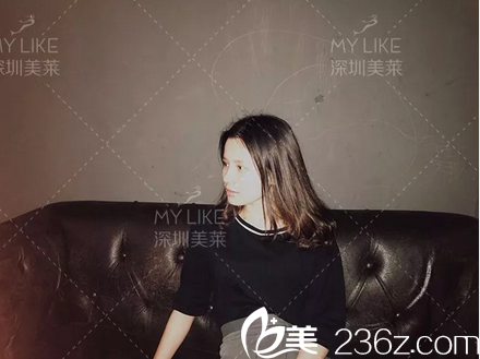 在深圳美萊做雙眼皮隆鼻半個月了 在深圳美萊做雙眼皮隆鼻半個月了