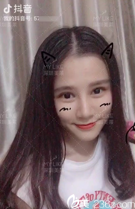 找深圳美萊陳磊做完雙眼皮隆鼻后開始抖音直播 找深圳美萊陳磊做完雙眼皮隆鼻后開始抖音直播