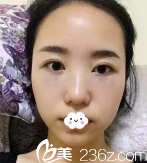 阜陽東方美萊塢去眼袋效果怎么樣？