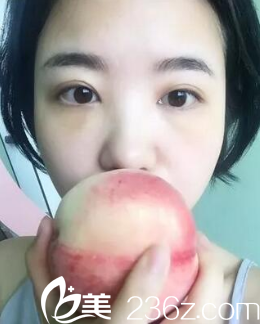 阜陽東方美萊塢韓式無痕去眼袋案例圖