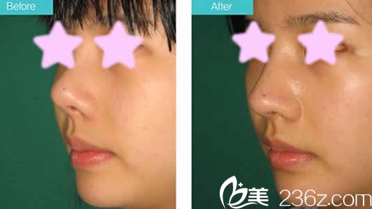 太原歐美蓮整形雷雪華鼻綜合案例效果圖