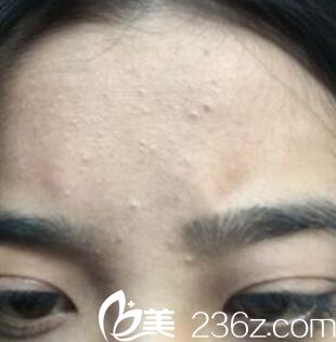 額頭的痘痘