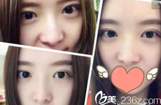 太原歐美蓮姚冰雙眼皮案例效果圖