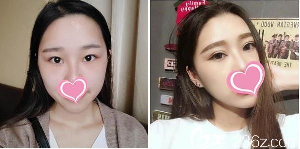 贛州韓美整形醫(yī)院雙眼皮手術(shù)案例