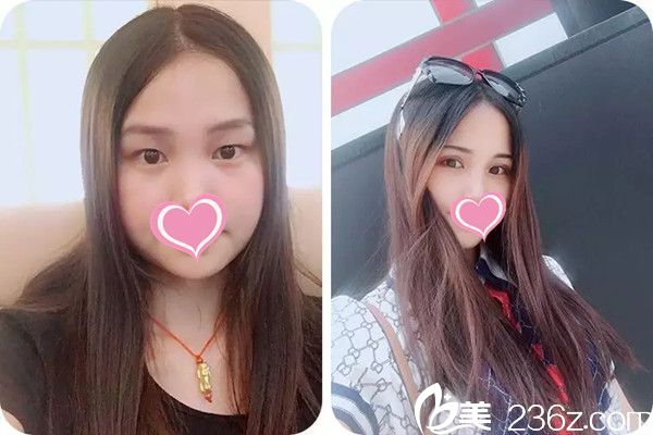 贛州長(zhǎng)安整形雙眼皮手術(shù)案例