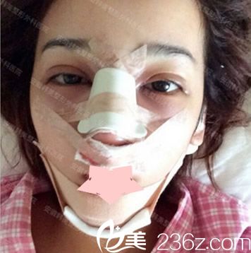 找合肥韓美整形閆品行做隆鼻失敗修復(fù)及割雙眼皮第2天樣子 找合肥韓美整形閆品行做隆鼻失敗修復(fù)及割雙眼皮第2天樣子