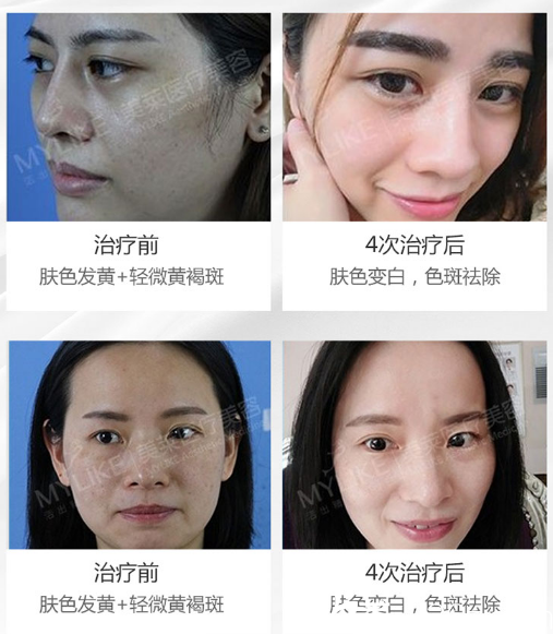 佛山美萊王晶瑜做的超皮秒祛斑效果圖