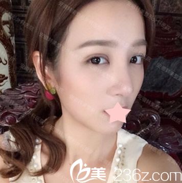 在合肥韓美做隆鼻失敗修復(fù)+全切雙眼皮術(shù)后第20效果圖一覽 在合肥韓美做隆鼻失敗修復(fù)+全切雙眼皮術(shù)后第20效果圖一覽