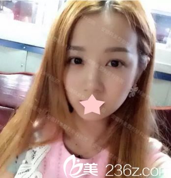 被注射假玻尿酸鼻子變寬照片 被注射假玻尿酸鼻子變寬照片