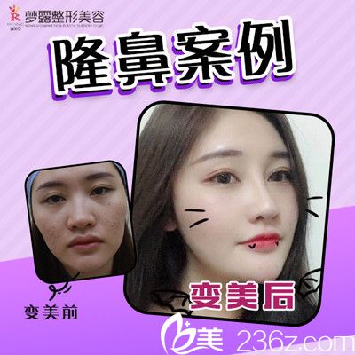 佛山夢露整形醫(yī)院隆鼻案例對比圖