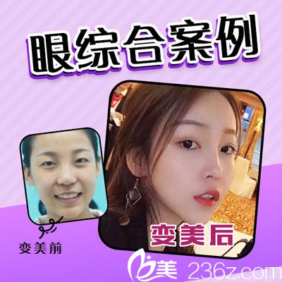 佛山夢露整形醫(yī)院孫文娜醫(yī)生做的雙眼皮案例