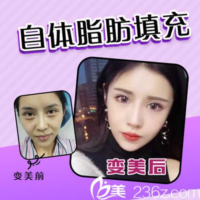 佛山夢露游萬福做的自體脂肪面部填充案例