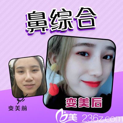 佛山夢露整形醫(yī)院游萬福做的鼻綜合隆鼻案例