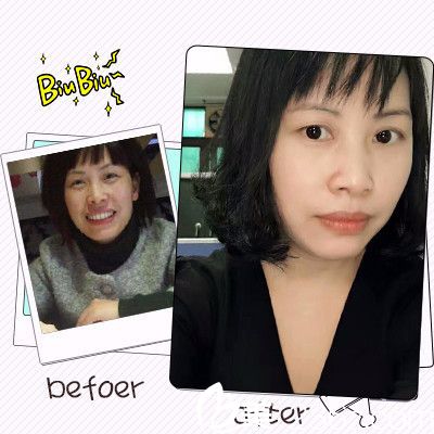 佛山夢露整形醫(yī)院除皺案例