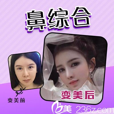 佛山夢露游萬福做的隆鼻失敗修復案例