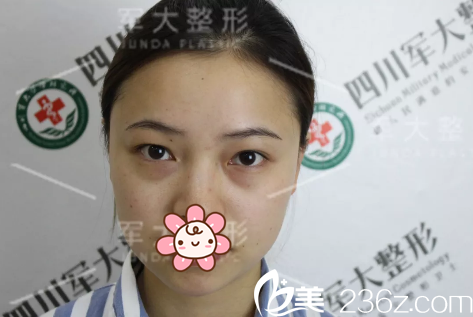成都軍大整形外科醫(yī)院文科術(shù)前照片1