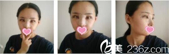 昆明吳氏嘉美卓星美容醫(yī)院張昕霞全切雙眼皮+假體隆鼻真人案例術(shù)后第五天 昆明吳氏嘉美卓星美容醫(yī)院張昕霞全切雙眼皮+假體隆鼻真人案例術(shù)后第五天