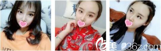 愛美的我去昆明吳氏嘉美卓星找張昕霞做了全切雙眼皮+假體隆鼻，一個月的時間就恢復的差不多了