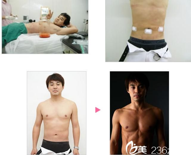 院長吸脂 院長吸脂