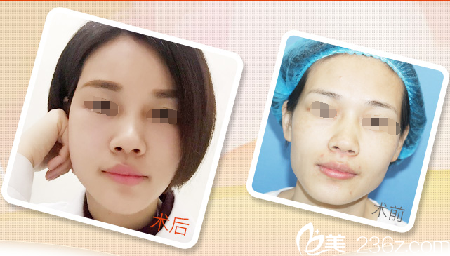 自體脂肪填充術前術后對比 自體脂肪填充術前術后對比