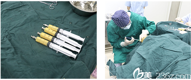 自體脂肪填充全臉手術中 自體脂肪填充全臉手術中