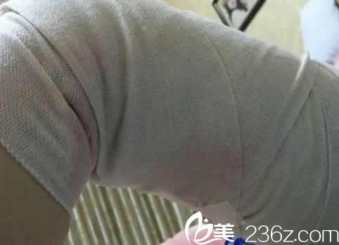 我在聊城韓美整形做水動(dòng)力腿部吸脂手術(shù)當(dāng)天照片