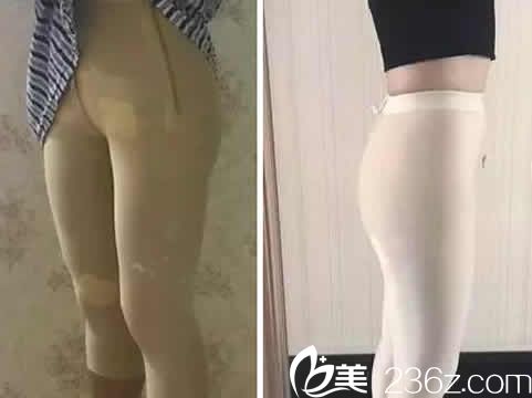 我在聊城韓美整形做無(wú)痛水動(dòng)力吸脂后第3天照片