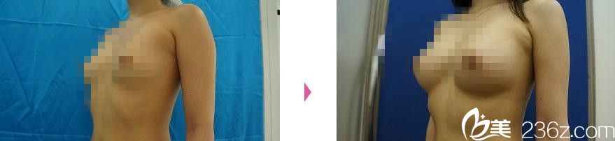 自體脂肪豐胸 自體脂肪豐胸