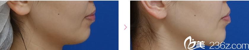 小臉形成術 小臉形成術