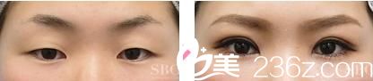 切開法雙眼皮和眼瞼下垂
